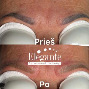 permanento šalinimas lazeriu